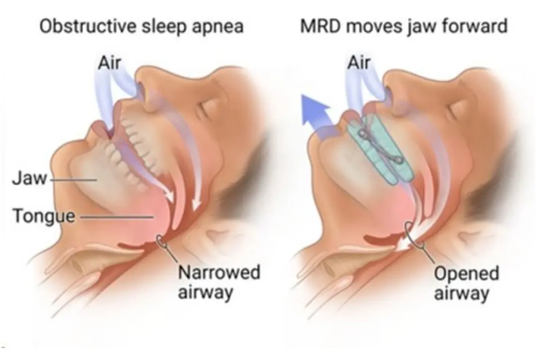 Oral mouthpiece for sleep apnea placed on bedside table next to CPAP mask