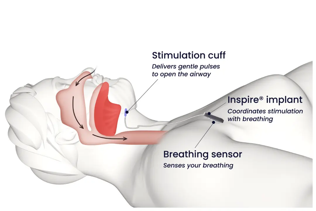Sleep apnea surgery and implant consultation with specialist
