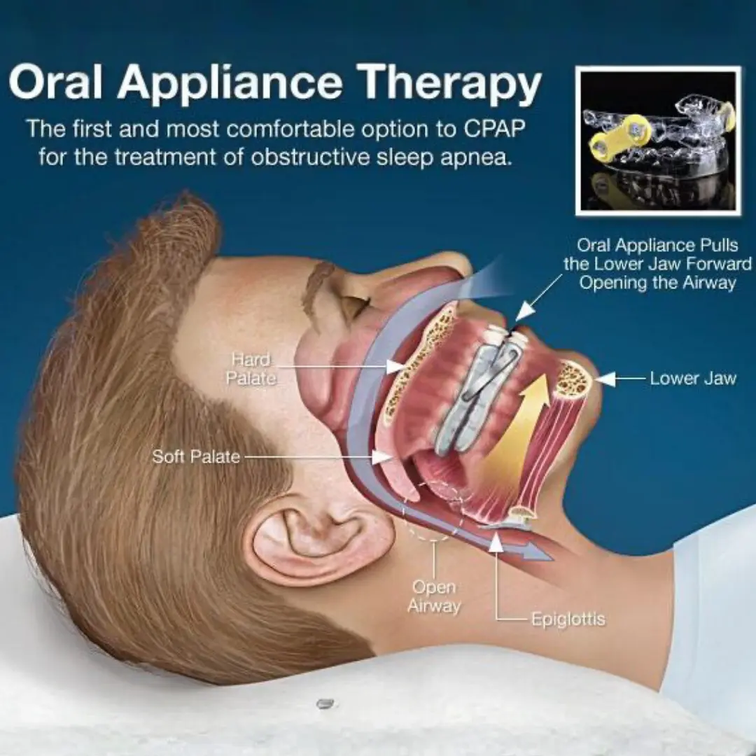 Illustration of different CPAP alternatives including oral mouthpiece and positional therapy pillow