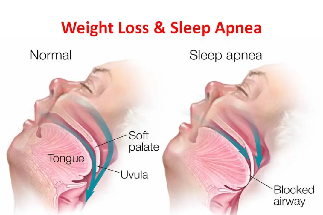 Person exercising outdoors as part of sleep apnea lifestyle improvement