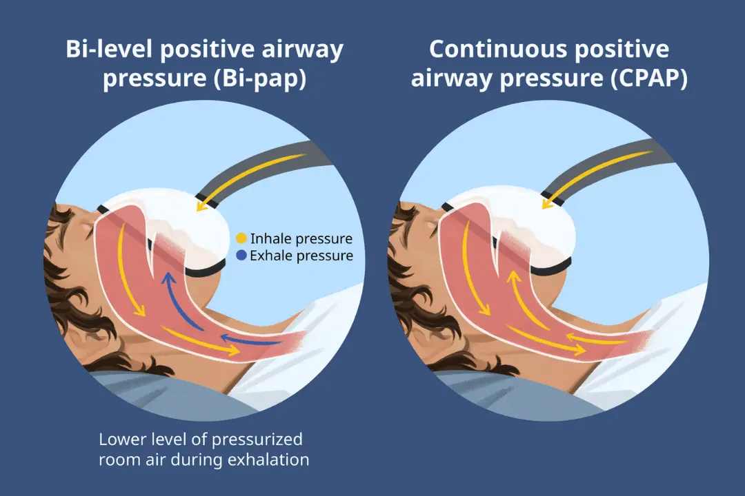 Patient sleeping comfortably using BiPAP mask connected to apnea machine